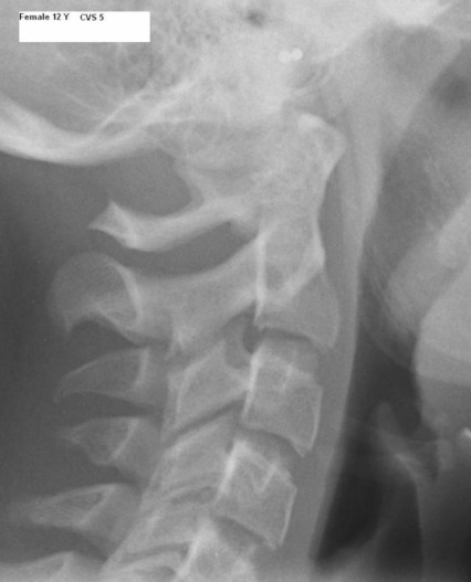 Cervical Vertebral Maturation CVM ZWP Online Das