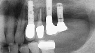 Minimalinvasive Möglichkeit der Ridge Preservation