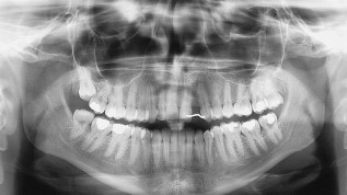 Interproximale Wurzelspreizung für eine Implantatinsertion
