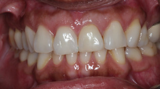 Sofortinsertion und Sofortbelastung eines Keramikimplantats