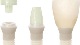 Innovative Implantatprothetik dank Glasfaseraufbau