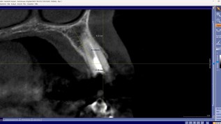 Labial kompromittierte Alveole: Versorgung mit Magnesiummembran