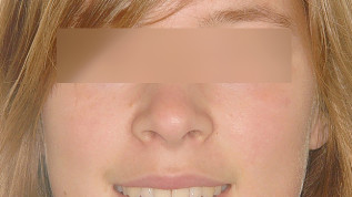Kieferorthopädischer Lückenschluss bei Nichtanlagen und Zahnverlust