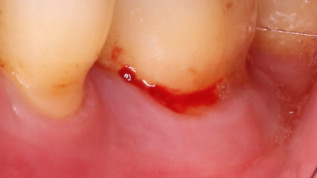 Fallvorstellungen zur Behandlung tiefer Zahnfleischtaschen