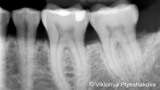 Nichtchirurgische Therapie tiefer PA-Defekte mit NaOCl-Gel und vernetzter Hyaluronsäure