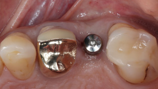 Erfolgreiche Behandlung eines Periimplantitisdefekts