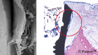 Periimplantitis: Mit neuartigem Konzept vermeidbar