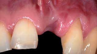 Periimplantäre Weichgewebsvermehrung um ZrO2-Implantate