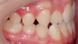 Dentoalveoläre Kompensation der Klasse III-Malokklusion mit Lingualtechnik