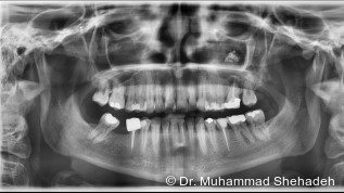 Fungusball in der Kieferhöhle nach Wurzelkanalbehandlung