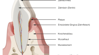 Kieferorthopädische Behandlung von parodontal erkrankten Patienten (Teil 1)