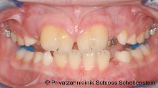 Gemination im Frontzahnbereich: Zahntransplantation als Therapieoption