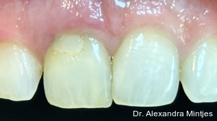 Zur Behandlung einer ausgeprägten zervikalen Resorption mit ästhetischem Outcome