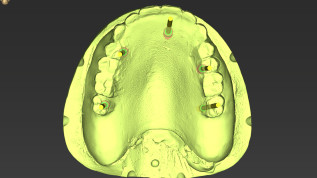 cranium-Patientenfall: Implantation im Oberkiefer mit Sofortversorgung