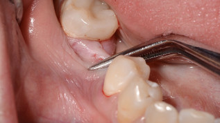 Periostbasierte Regenerationstechnik zur alveolären Knochenaugmentation