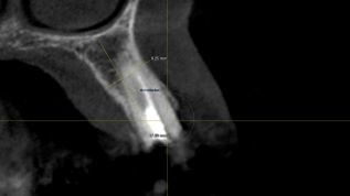 Labial kompromittierte Alveole: Versorgung mit Magnesiummembran
