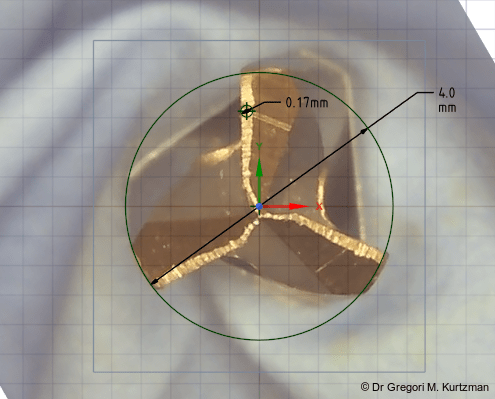 Fig. 1: Wear noted on stainless steel drill after repeated osteotomy preparation use.