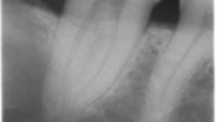 cranium-Patientenfall: Zufallsbefund keratozystischer odontogener Tumor