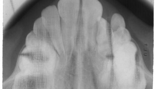 DVT-Diagnostik zur OP-Planung bei Zahntransplantation