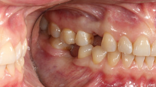 Implantation und Augmentation eines bukkalen Knochendefekts