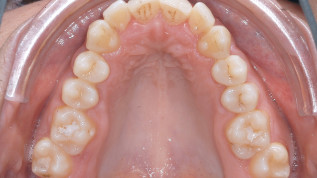 Chirurgische Gaumennahterweiterung oder transversale dentoalveoläre Kompensation?
