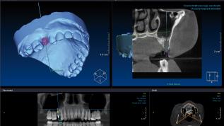 Möglichkeiten und Grenzen von Keramikimplantaten