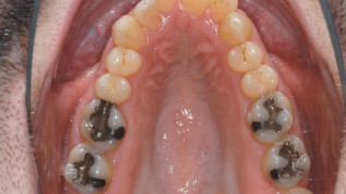 Chirurgische Gaumennahterweiterung versus transversale dentoalveoläre Kompensation