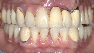 Doppelkronen-Konzept mit keramischen ­Primär- und Galvano-Sekundärteilen