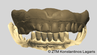 Kombiarbeit und digitale Totalprothetik – Effizienz durch CAD/CAM mit SLM-Verfahren