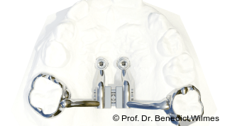 Mehrfachnutzung palatinaler Miniimplantate: Oberkieferexpansion und Molarenintrusion
