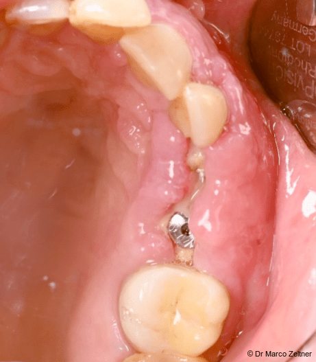 Fig.11a: Soft-tissue healing following surgery.