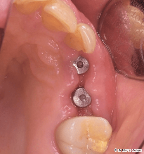 Fig. 11b: Soft-tissue healing following surgery.