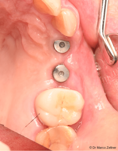 Fig. 12: Healed soft tissues and successful implant osseointegration before intraoral scanning for fabrication of the definitive prosthetic restoration.