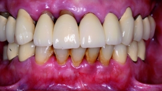 Navigierte Osteoplastik mit Sofortversorgung