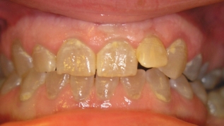 Dentinogenesis imperfecta hereditaria
