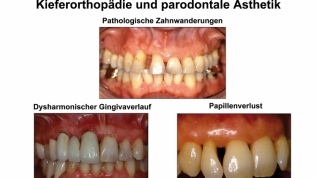 Kieferorthopädie und parodontale Ãsthetik