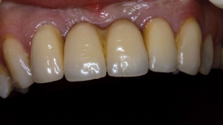 Implantate in der Ã¤sthetischen Zone