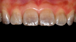 Keramikveneers - eine klinische Übersicht