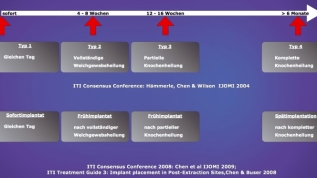 Implantation im Frontzahnbereich