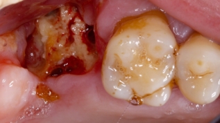 Zahnerhalt vs. Implantation - Ein Konzept