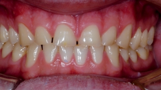 Bisshebung und No Prep Veneers - ein Widerspruch?