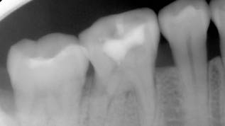 Grenzen der endodontischen Zahnerhaltung