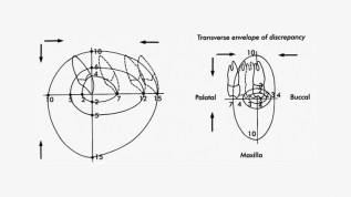 Nichtoperative maxilläre Expansion