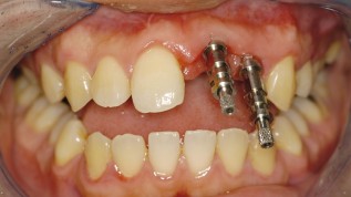 Die Implantatabformung