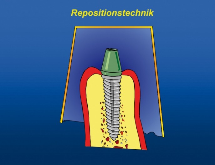 Die Implantatabformung Drei Techniken Im Überblick Zwp Online Das Nachrichtenportal Für 3632