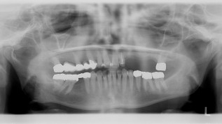 Ein Ansatz zur zeitnahen Implantatversorgung