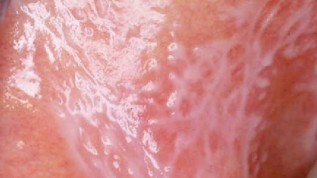 Der orale Lichen planus