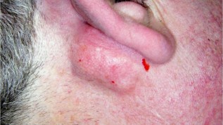 Mit Licht Lipome behandeln