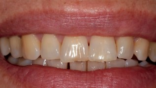Komplexe Restauration - non- und minimalinvasiv