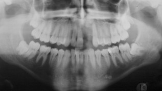 Knochendefizite mit Transplantaten ausgleichen